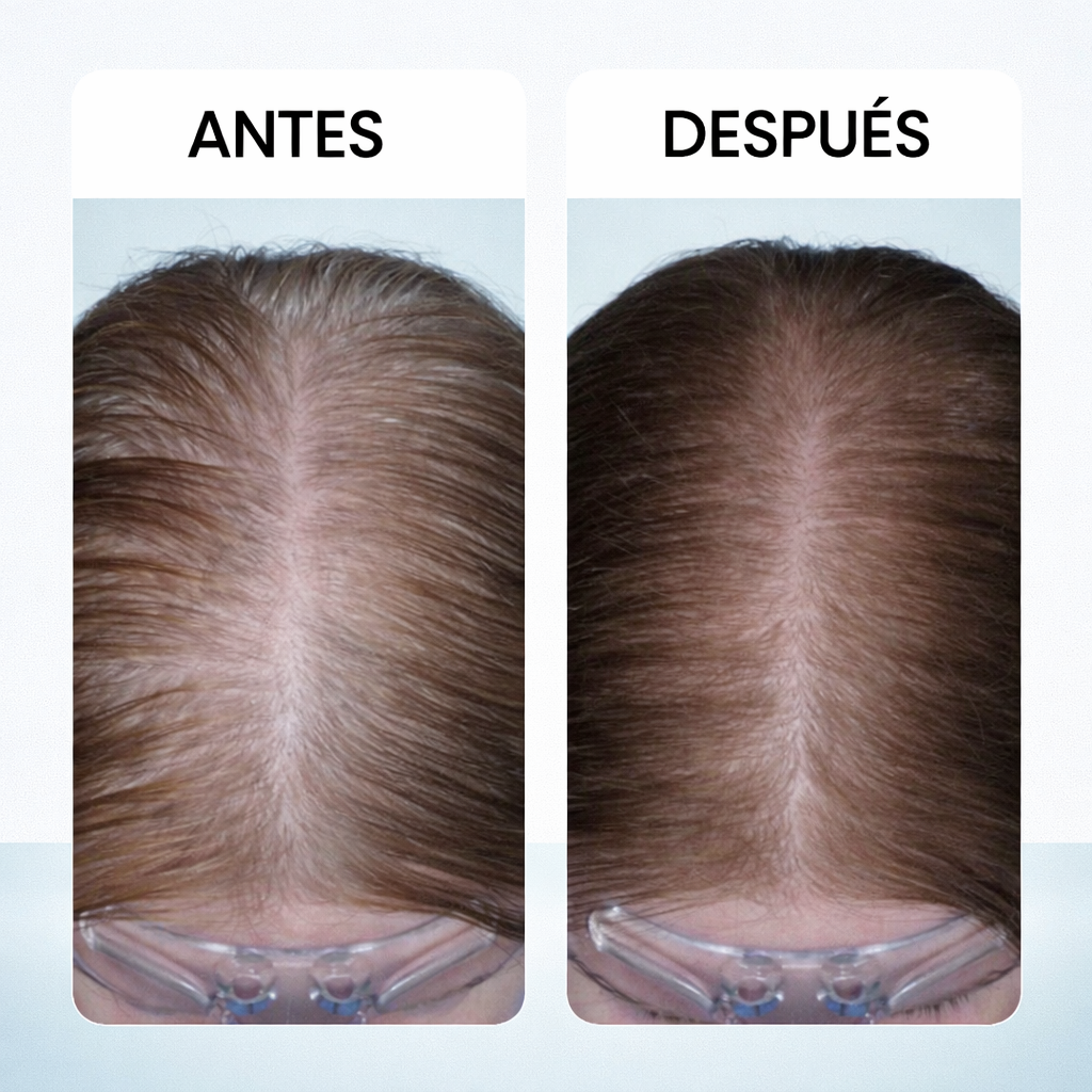 Reduce la Caída del Cabello – Masajeador Capilar Scalp Lux