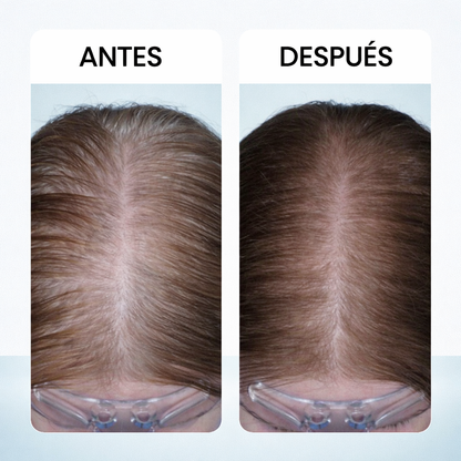 Reduce la Caída del Cabello – Masajeador Capilar Scalp Lux